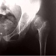 Congenital dislocation of the hip 11.jpg