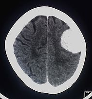 Contrast enhanced meningioma.jpg