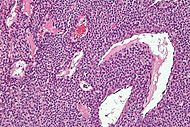 Glomus tumour - high mag.jpg