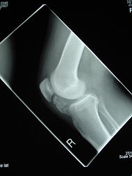 Osteochondroma X-ray.jpg