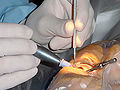 Cataract surgery.jpg