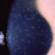 Meesmann corneal dystrophy - Multiple opaque spots in the corneal epithelium.JPEG