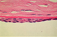 Posterior polymorphous corneal dystrophy 1.JPEG