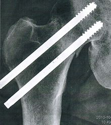 Femoral neck fracture, right hip.jpg